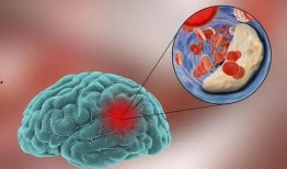 脑梗塞吃瓜尖,天然食疗新选择