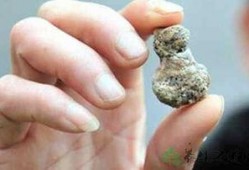 肾结石可以吃毛瓜